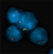 A bone marrow smear of lymphoblasts (leukemic cells in ALL)