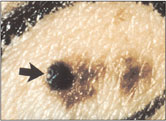 This photo shows a dysplastic nevus with an arrow pointing to a new black bump that was not there 18 months earlier.