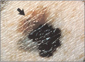 This photo shows an asymmetic melanoma with irregular and scalloped borders.