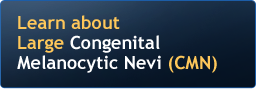 Learn about Large Congenital Melanocytic Nevi