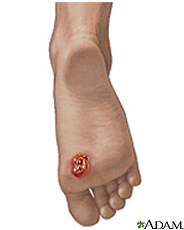 Ilustración de sarcoma de Kaposi en el pie