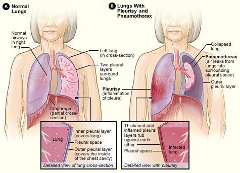 Figure A shows the location of the lungs, airways, pleura, and diaphragm (a muscle that helps you breathe). The inset image shows a detailed view of the two pleural layers and pleural space. Figure B shows lungs with pleurisy and a pneumothorax. The inset image shows a detailed view of an infected lung with thickened and inflamed pleural layers.
