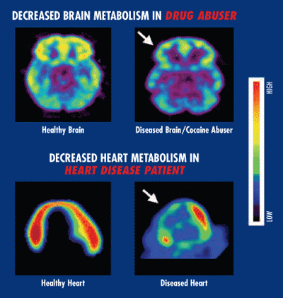 Brain and heart metabolism image