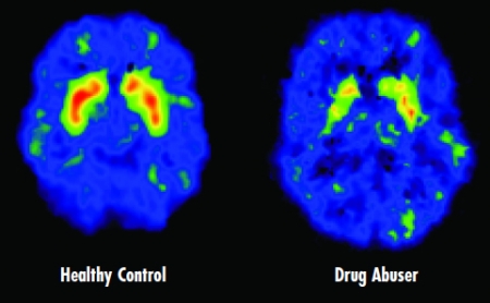 Brain scans of a health brain and a brain of a drug abuser