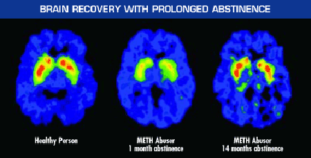 Recovery of Brain Function With Prolonged Abstinence image