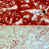 Two microscope images of liver, the top one heavily marbled with red.