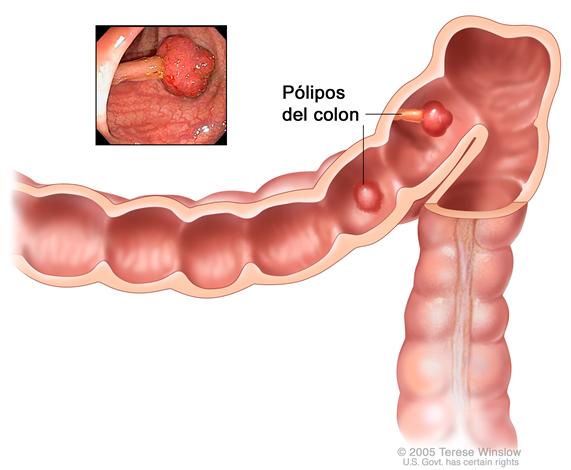 Pólipos del colon; muestra dos pólipos (uno plano y otro pedunculado) en el interior del colon. El recuadro interior muestra imagen de un pólipo pedunculado.