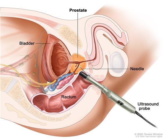 Transrectal biopsy; drawing shows a side view of the prostate, bladder, and rectum. Drawing also shows an ultrasound probe with a needle inserted into the rectum to remove a tissue sample from the prostate.