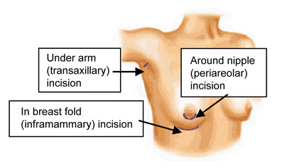 Female torso showing three incision points: under arm transaxillary incision, breast fold inframammary incision, and around nipple periareolar incision.