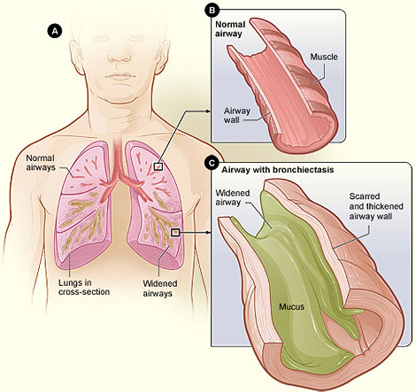 Figure A shows a cross-section of the lungs with normal airways and with widened airways. Figure B shows a cross-section of a normal airway. Figure C shows a cross-section of an airway with bronchiectasis.