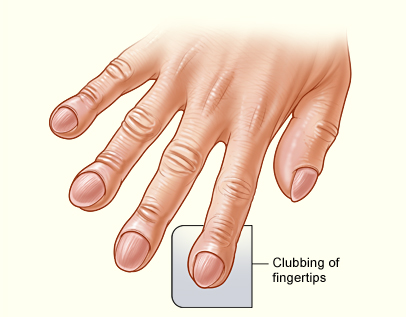 The illustration shows clubbing of the fingertips associated with idiopathic pulmonary fibrosis.