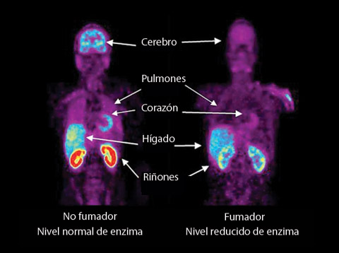 Foto de dos neuroimágenes, el primero muestra el nivel normal de la enzima monoaminooxidasa, el otro muestra el nivel reducido del enzima por causa de fumar.
