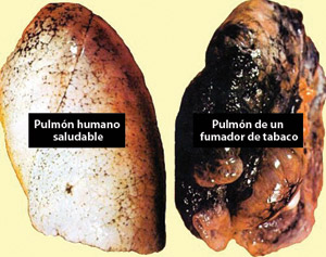 Foto de dos pulmones. Uno es saludable y el otro muestra los efectos de fumar tabaco.   