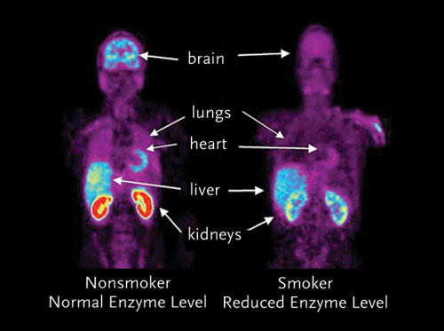 Upper torso scan of a non-smokernext to a smoker.