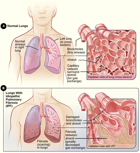 Figure A shows the location of the lungs and airways in the body. The inset image shows a detailed view of the lung's airways and air sacs in cross-section. Figure B shows fibrosis (scarring) in the lungs. The inset image shows a detailed view of the fibrosis and how it damages the airways and air sacs.