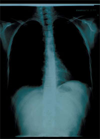 Imagen de una radiografía de tórax