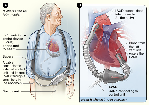 Figure A shows the location of the heart and the typical equipment needed for an implantable LVAD. Figure B shows how the LVAD is connected to the heart.