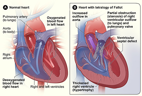 Figure A shows the structure and blood flow in the interior of a normal heart. Figure B shows a heart with the four defects of tetralogy of Fallot.
