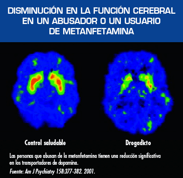 Disminución de la función cerebral en un abusador o usuario de la metanfetamina. Esta imagen muestra dos cerebros. El cerebro vista a la izquierda es saludable. El cerebro a la derecha se ve afectado por la metanfetamina
