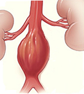 Drawing of an abdominal aortic aneurysm.