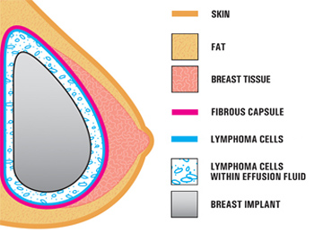 FDA Offers Advice to Women with Implants - Illustration