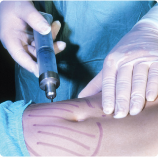 Liposuction being performed on a patient's abdomen. The process involves inserting a needle through the skin and drawing out some of the underlying fat.