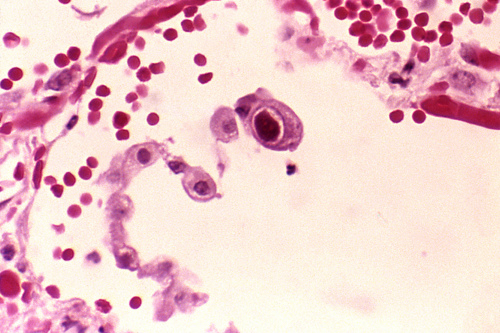 Image description: This photomicrograph shows human lung cells infected with cytomegalovirus, a common pathogen that is particularly dangerous for infants and persons with weakened immune systems. The large dark red mass in the center is the cell that shows the virus particles in its nucleus.
Learn how the National Institute of Standards and Technology is helping diagnose and treat cytomegalovirus.
Photo by E.P. Ewing, Centers for Disease Control and Prevention