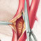 Illustration showing steps in carotid endarterectomy 
