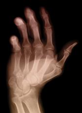 X-ray of an arthritic hand