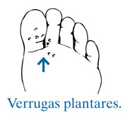 Ilustración de la planta de un pie con una flecha que señala hacia verrugas plantares