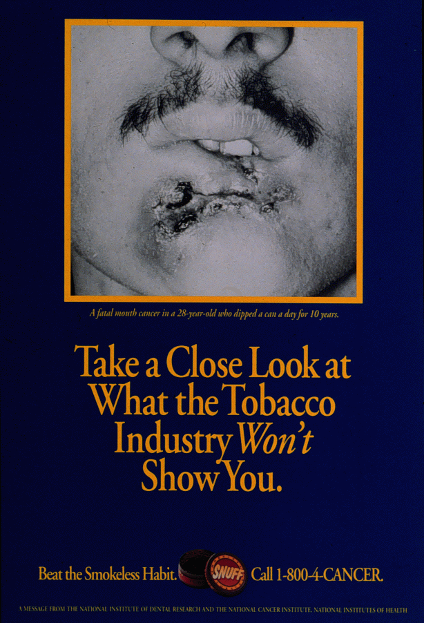 Poster: Take a Close Look at What the Tobacco Industry Won't Show You. A picture of a fatal mouth cancer in a 28-year-old who dipped a can a day for 10 years. Beat the Smokeless Habit. Call 1-800-4-CANCER.