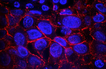 Breast cancer cells with nuclei stained blue and the HER2 protein in red.