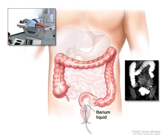 Barium enema procedure; shows barium liquid being put into the rectum and flowing through the colon.  Inset shows person on table having a barium enema.