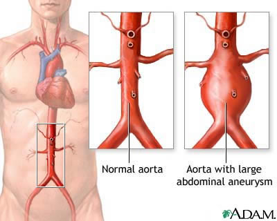 Illustration: Abdominal aortic aneurysm