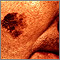 Cáncer de piel: primer plano del melanoma léntigo maligno