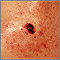 Cáncer de piel: primer plano del melanoma de nivel IV