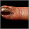 Skin cancer, melanoma on the fingernail