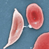 Electron micrograph of a sickle shaped cell on the left and several rounded cells on the right.