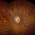 Photo of a retina.