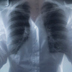 photo of a lung x-ray held in front of a woman's chest.