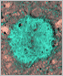 an image of a blue-green fibrous mass in the brain