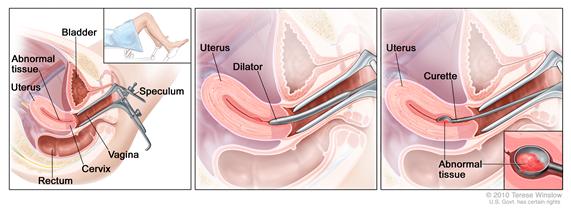 Dilatation and curettage (D and C). Three-panel drawing showing a side view of the female reproductive anatomy during a D and C procedure. The first panel shows a speculum widening the opening of the vagina. The cervix, uterus with abnormal tissue, bladder, and rectum are also shown; an inset shows the lower half of a woman covered by a drape on an exam table with her legs apart  and her feet in stirrups. The middle panel shows the uterus and a dilator inserted through the vagina into the cervix. The third panel shows a curette scraping out abnormal tissue from the uterus; an inset shows a close up of the curette with the abnormal tissue in it.