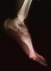 Photograph of an x-ray of a foot
