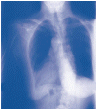 image of laboratory tests of fluid or tissue from the lungs