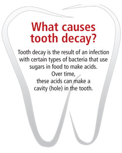 What causes tooth decay? Tooth decay is the result of an infection with certain types of bacteria that use sugars in food to make acids. Over time, these acids can make a cavity (hole) in the tooth.