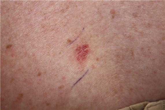 Photograph of a pink, scaly lesion on the skin.