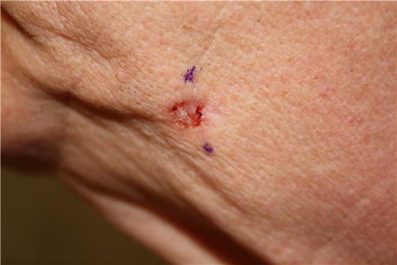 Photograph of a red, ulcerated lesion on the skin of the face.