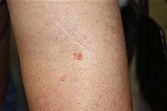 Photograph of a pink, raised lesion on the skin of the leg.