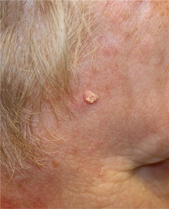 Photograph of a pink, raised lesion on the skin of the face.