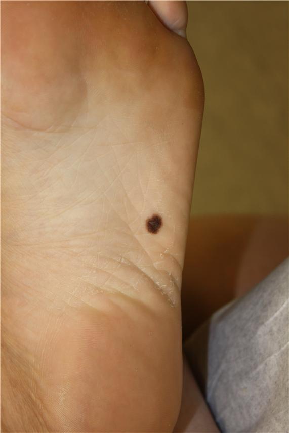 Photograph of an asymmetrical, brown lesion on the skin on the bottom of the foot.